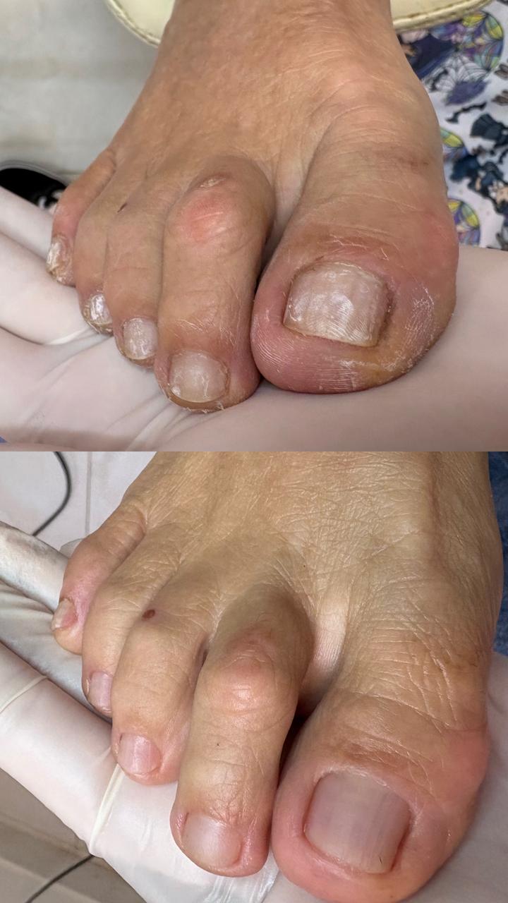 Antes e depois de tratamento podológico em Sorocaba