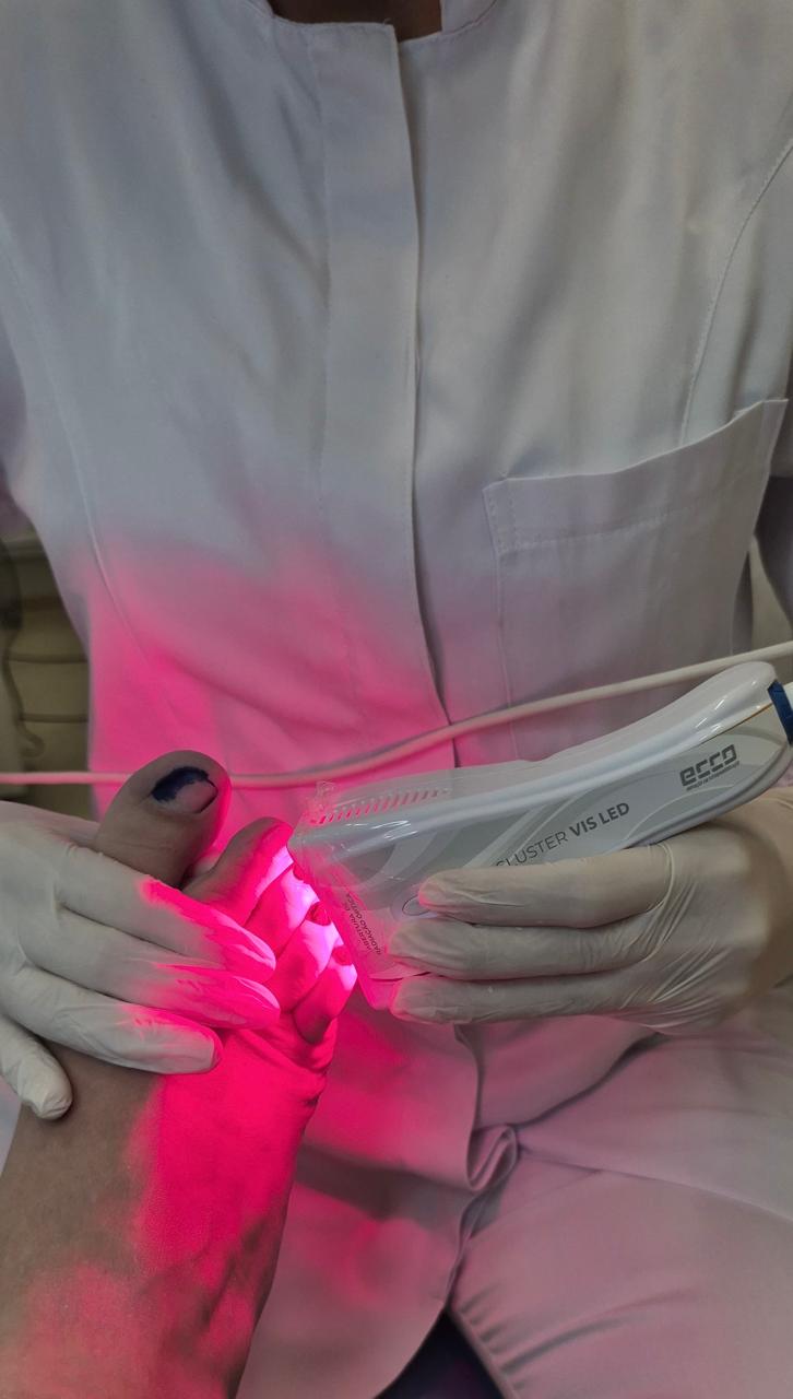 Laserterapia podológica em Sorocaba