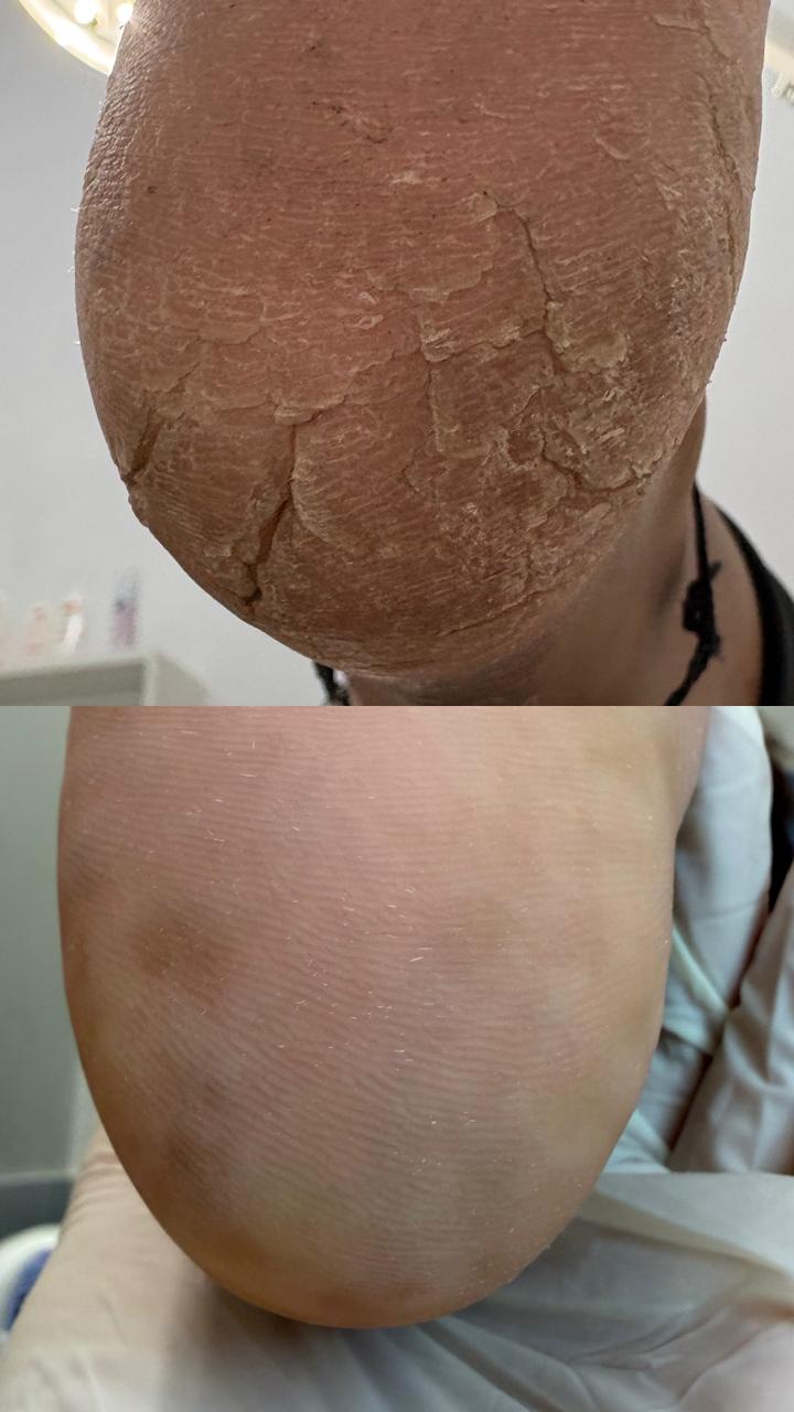 Revitalização plantar - podologia em Sorocaba